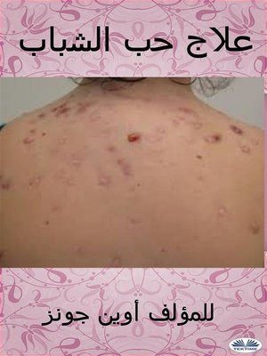 cover image of علاج حب الشباب